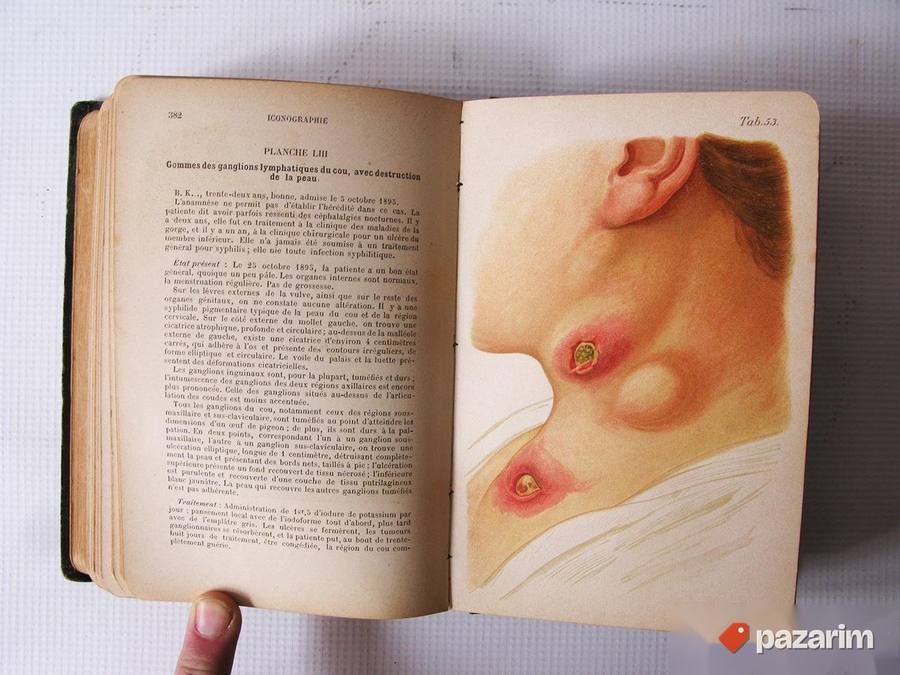 Atlas sifilisa i veneričnih bolesti. Retko! 7